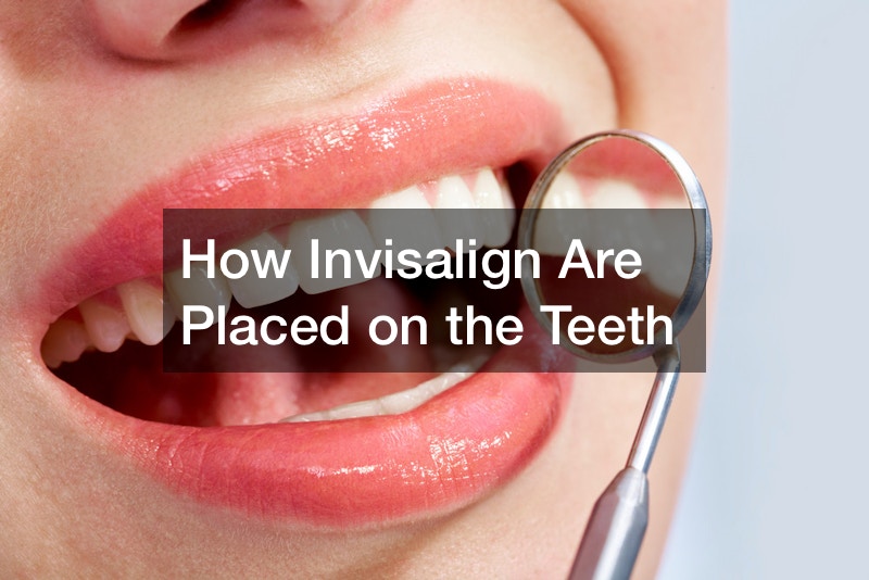 How Invisalign Are Placed on the Teeth